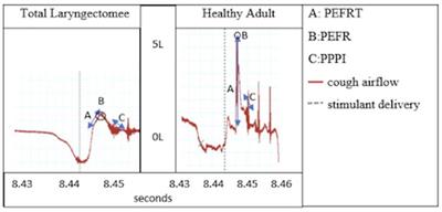 Impact of Tussigenic Stimuli on Perceived Upper Airway Sensation and Motor Cough Response Following Total Laryngectomy